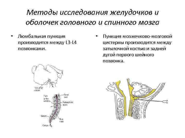 Методы исследования желудочков и оболочек головного и спинного мозга • Люмбальная пункция производится между