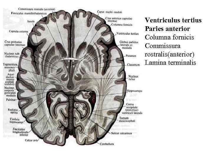 Ventriculus tertius Paries anterior Columna fornicis Commissura rostralis(anterior) Lamina terminalis 