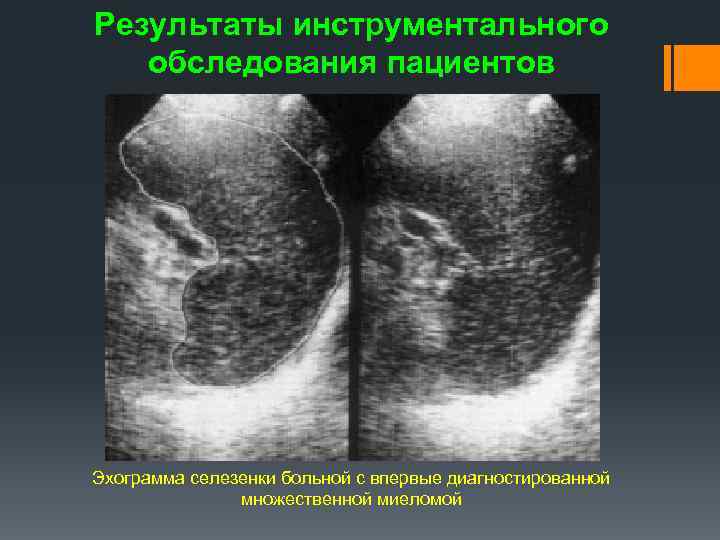 Результаты инструментального обследования пациентов Эхограмма селезенки больной с впервые диагностированной множественной миеломой 