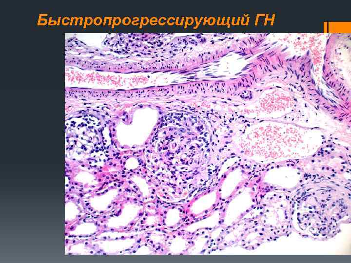 Быстропрогрессирующий ГН 