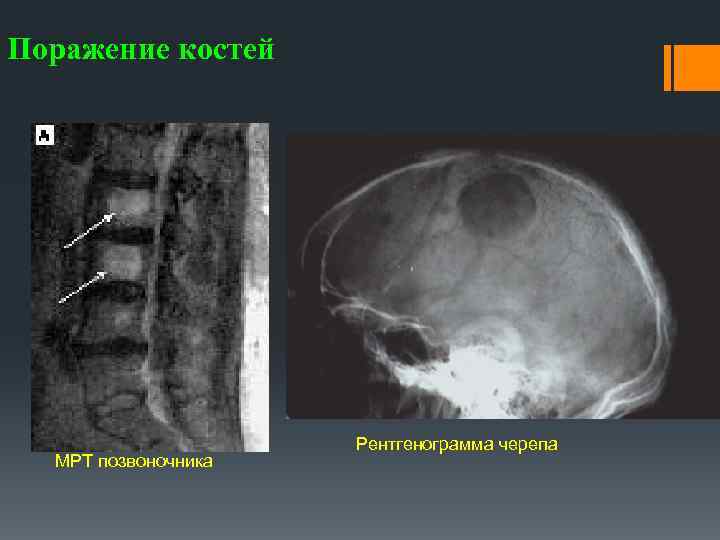 Поражение костей МРТ позвоночника Рентгенограмма черепа 