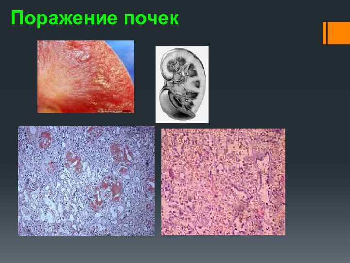 Поражение почек 