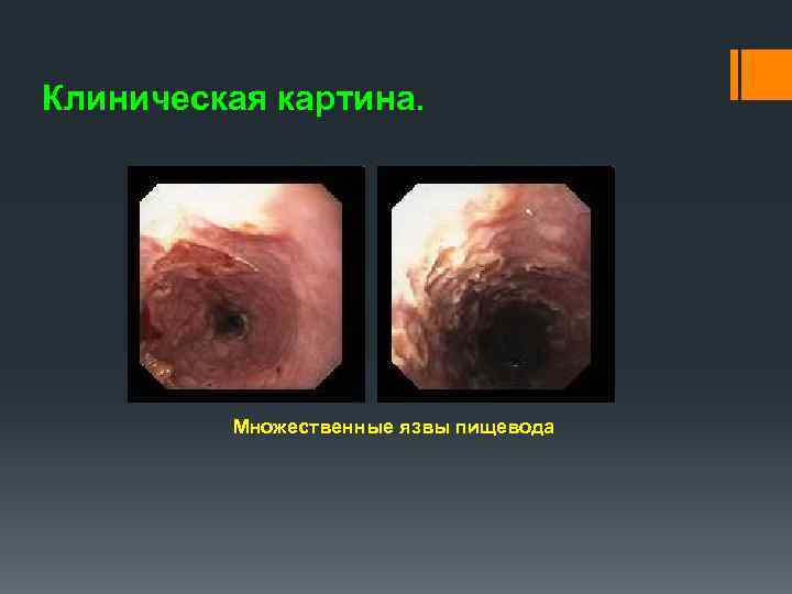 Клиническая картина. Множественные язвы пищевода 