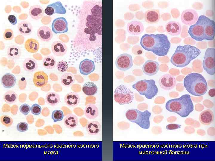 Мазок нормального красного костного мозга Мазок красного костного мозга при миеломной болезни 