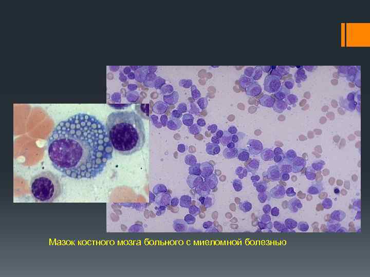 Мазок костного мозга больного с миеломной болезнью 