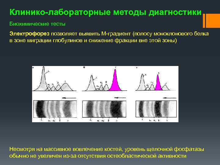 Клинико-лабораторные методы диагностики Биохимические тесты Электрофорез позволяет выявить М градиент (полосу моноклонового белка в
