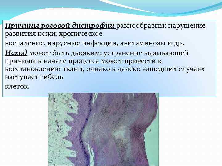 Причины роговой дистрофии разнообразны: нарушение развития кожи, хроническое воспаление, вирусные инфекции, авитаминозы и др.