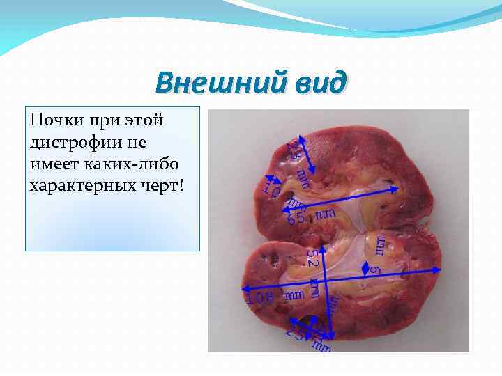 Внешний вид Почки при этой дистрофии не имеет каких-либо характерных черт! 