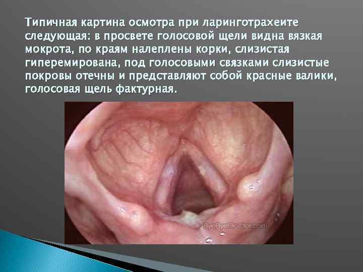 Типичная картина осмотра при ларинготрахеите следующая: в просвете голосовой щели видна вязкая мокрота, по