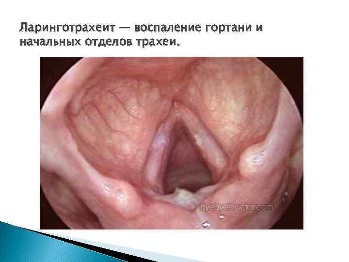 Ларинготрахеит — воспаление гортани и начальных отделов трахеи. 
