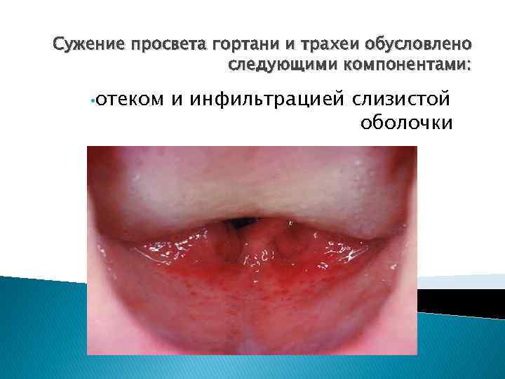 Сужение просвета гортани и трахеи обусловлено следующими компонентами: • отеком и инфильтрацией слизистой оболочки