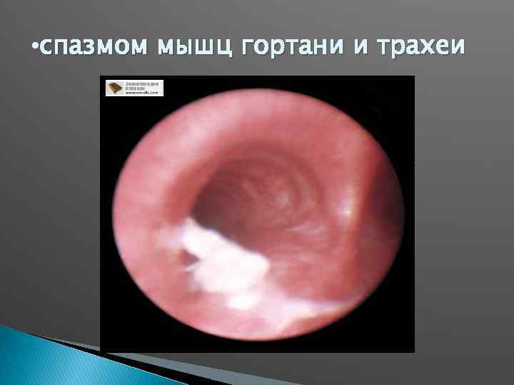  • спазмом мышц гортани и трахеи 