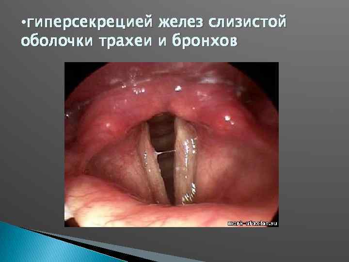  • гиперсекрецией желез слизистой оболочки трахеи и бронхов 