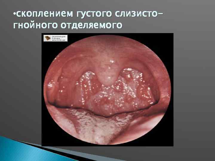  • скоплением густого слизистогнойного отделяемого 
