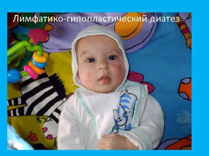 Лимфатико-гипопластический диатез 
