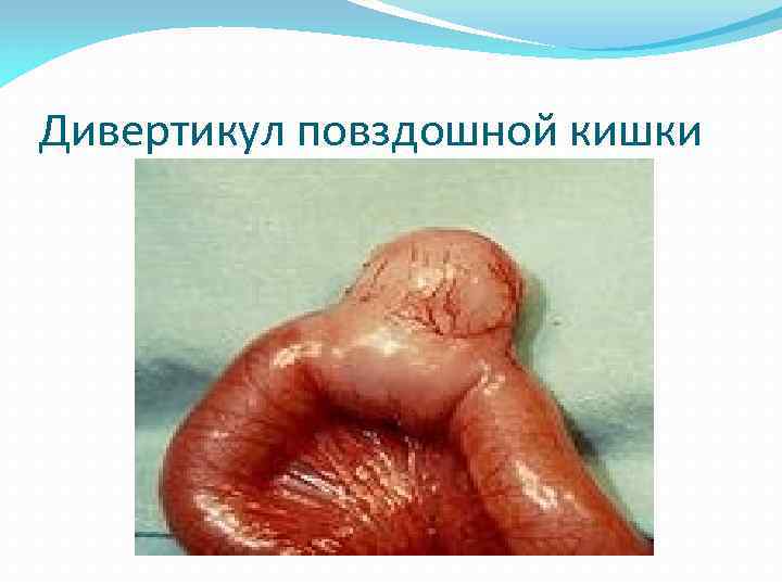 Дивертикул повздошной кишки 