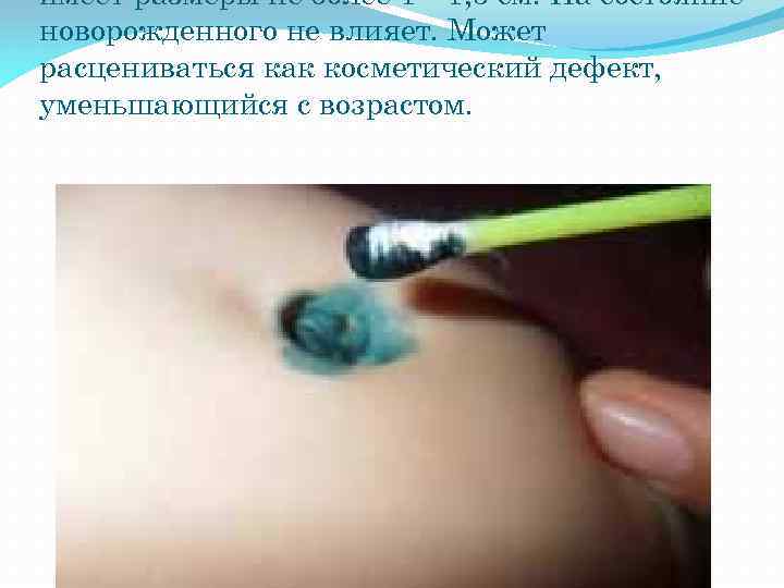 имеет размеры не более 1— 1, 5 см. На состояние новорожденного не влияет. Может