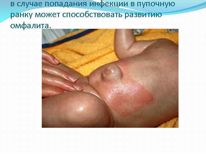 в случае попадания инфекции в пупочную ранку может способствовать развитию омфалита. 