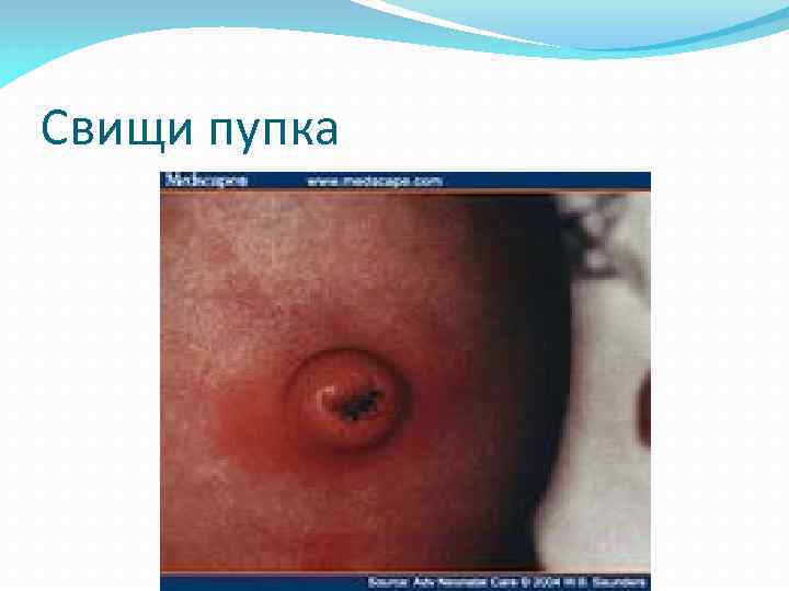 Свищи пупка 