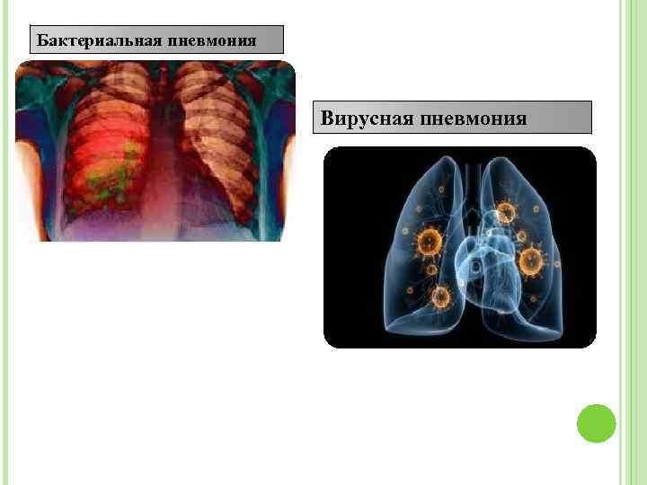 Клиническая картина бактериальной пневмонии