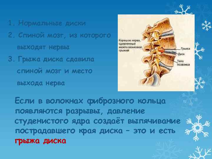1. Нормальные диски 2. Спиной мозг, из которого выходят нервы 3. Грыжа диска сдавила