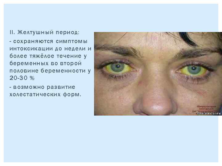 II. Желтушный период: - сохраняются симптомы интоксикации до недели и более тяжёлое течение у