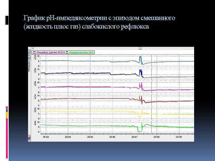 График р. Н-импедансометрии с эпизодом смешанного (жидкость плюс газ) слабокислого рефлюкса 