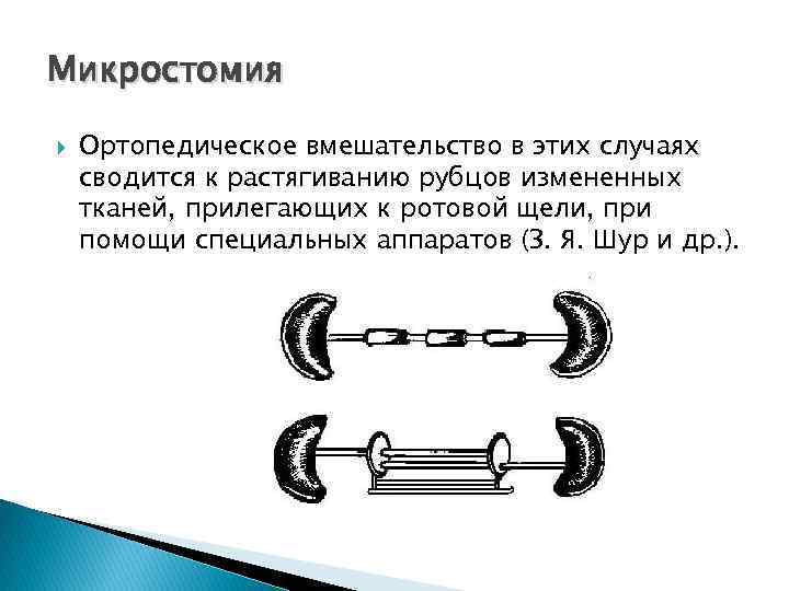 Микростомия Ортопедическое вмешательство в этих случаях сводится к растягиванию рубцов измененных тканей, прилегающих к