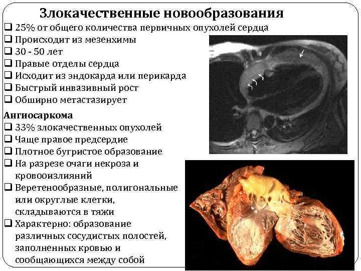 Злокачественные новообразования q 25% от общего количества первичных опухолей сердца q Происходит из мезенхимы