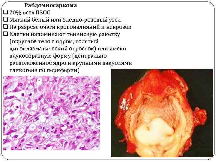 Рабдомиосаркома q 20% всех ПЗОС q Мягкий белый или бледно-розовый узел q На разрезе