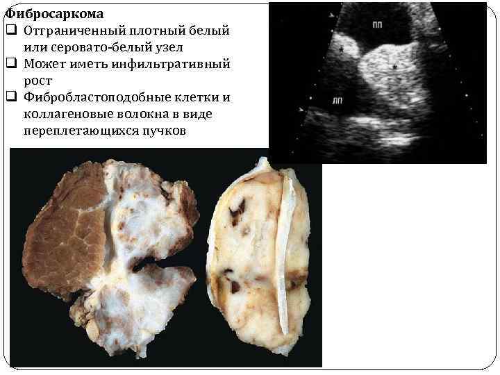 Фибросаркома q Отграниченный плотный белый или серовато-белый узел q Может иметь инфильтративный рост q