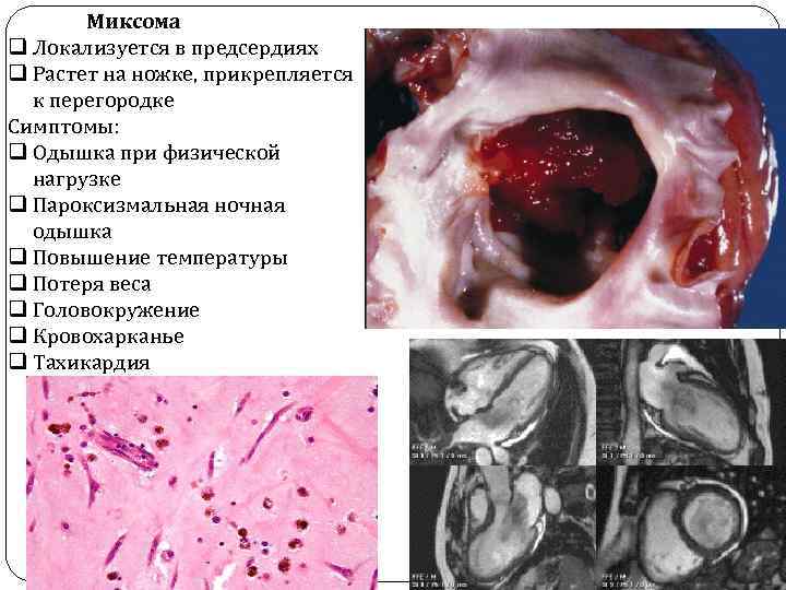 Миксома q Локализуется в предсердиях q Растет на ножке, прикрепляется к перегородке Симптомы: q