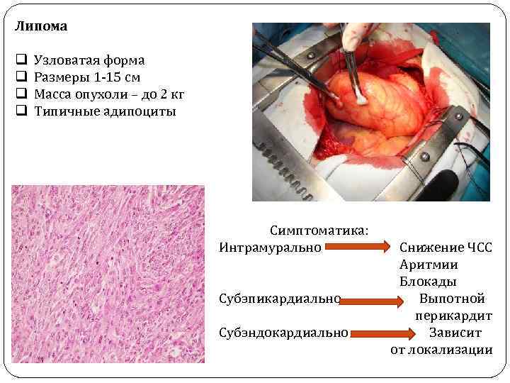 Липома q q Узловатая форма Размеры 1 -15 см Масса опухоли – до 2