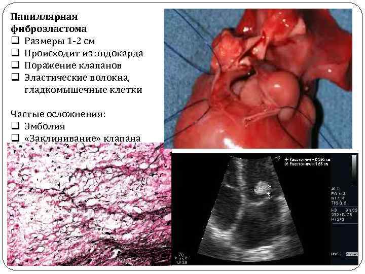 Папиллярная фиброэластома q Размеры 1 -2 см q Происходит из эндокарда q Поражение клапанов