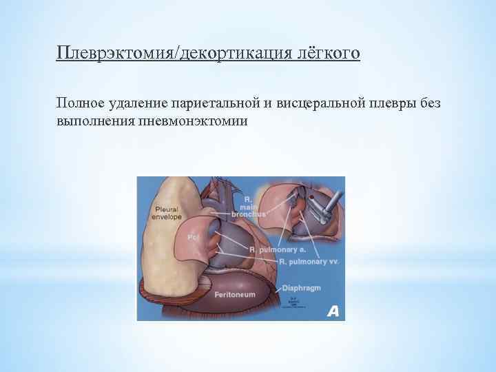 Плеврэктомия/декортикация лёгкого Полное удаление париетальной и висцеральной плевры без выполнения пневмонэктомии 