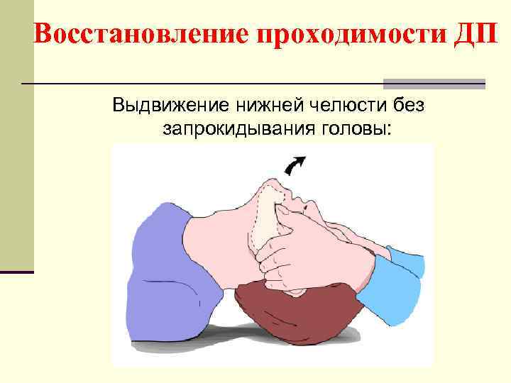 Восстановление проходимости ДП Выдвижение нижней челюсти без запрокидывания головы: 