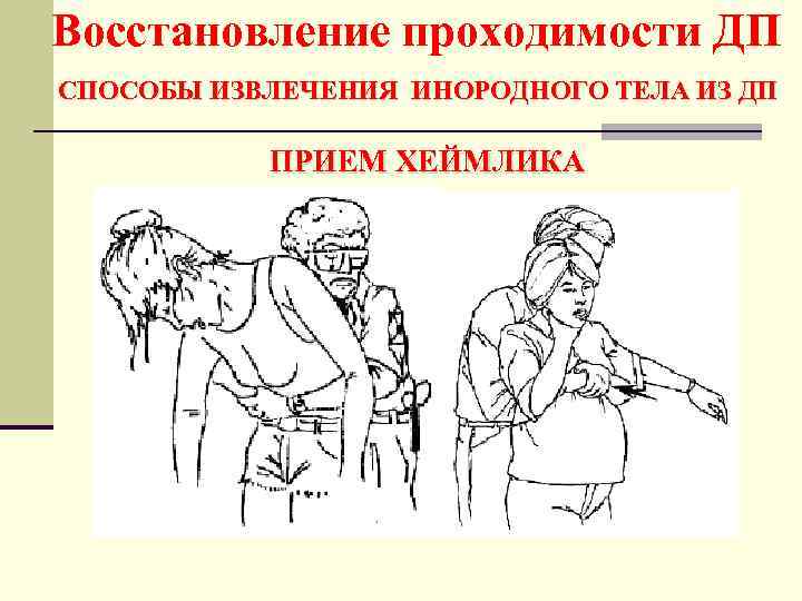 Восстановление проходимости ДП СПОСОБЫ ИЗВЛЕЧЕНИЯ ИНОРОДНОГО ТЕЛА ИЗ ДП ПРИЕМ ХЕЙМЛИКА 