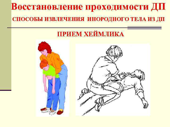 Восстановление проходимости ДП СПОСОБЫ ИЗВЛЕЧЕНИЯ ИНОРОДНОГО ТЕЛА ИЗ ДП ПРИЕМ ХЕЙМЛИКА 