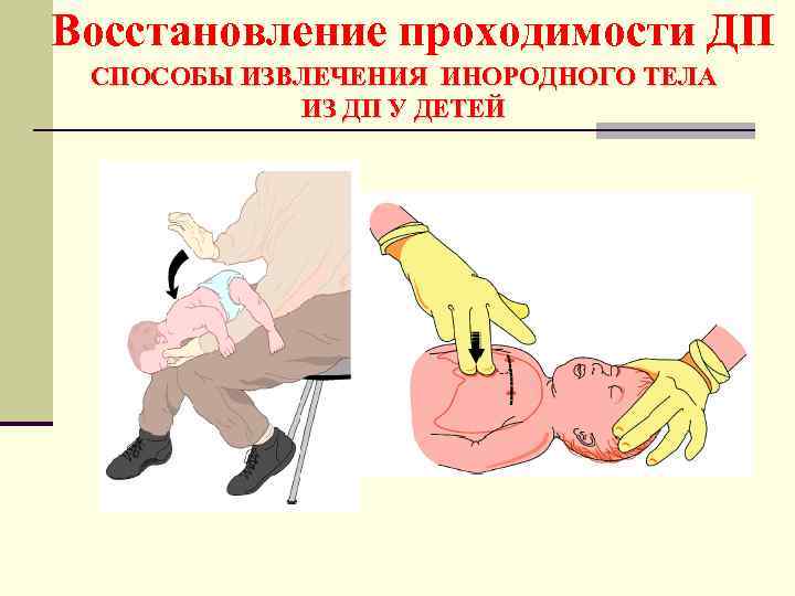 Восстановление проходимости ДП СПОСОБЫ ИЗВЛЕЧЕНИЯ ИНОРОДНОГО ТЕЛА ИЗ ДП У ДЕТЕЙ 