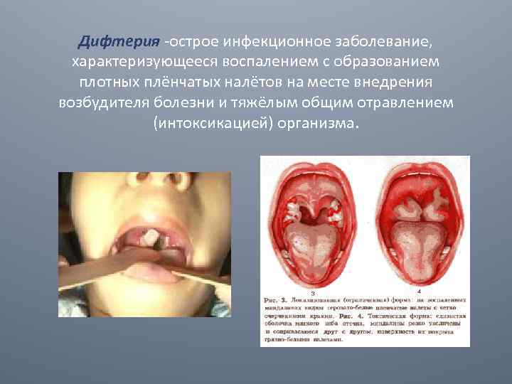 Дифтерия -острое инфекционное заболевание, характеризующееся воспалением с образованием плотных плёнчатых налётов на месте внедрения