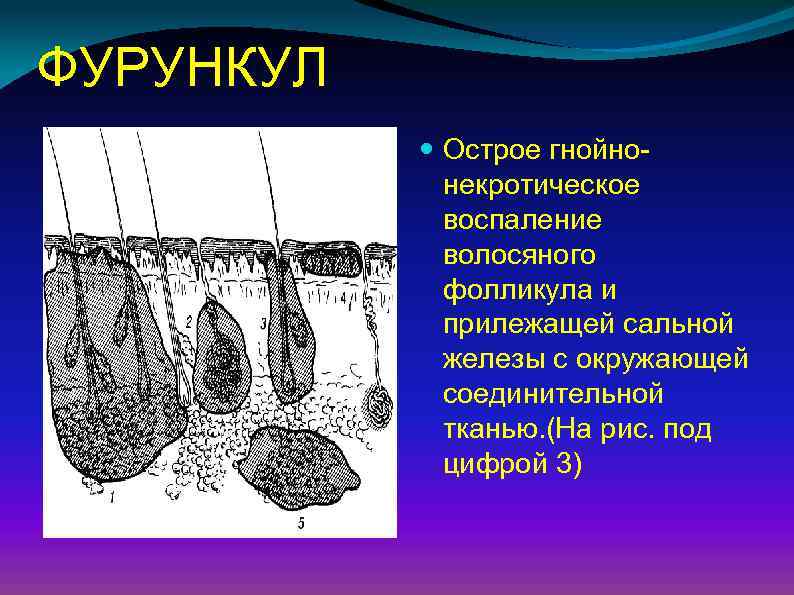 ФУРУНКУЛ Острое гнойнонекротическое воспаление волосяного фолликула и прилежащей сальной железы с окружающей соединительной тканью.