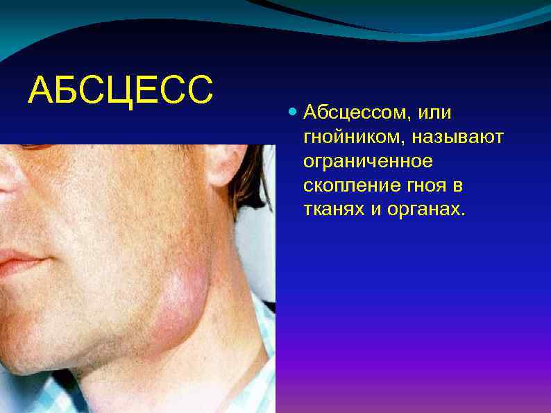 АБСЦЕСС Абсцессом, или гнойником, называют ограниченное скопление гноя в тканях и органах. 