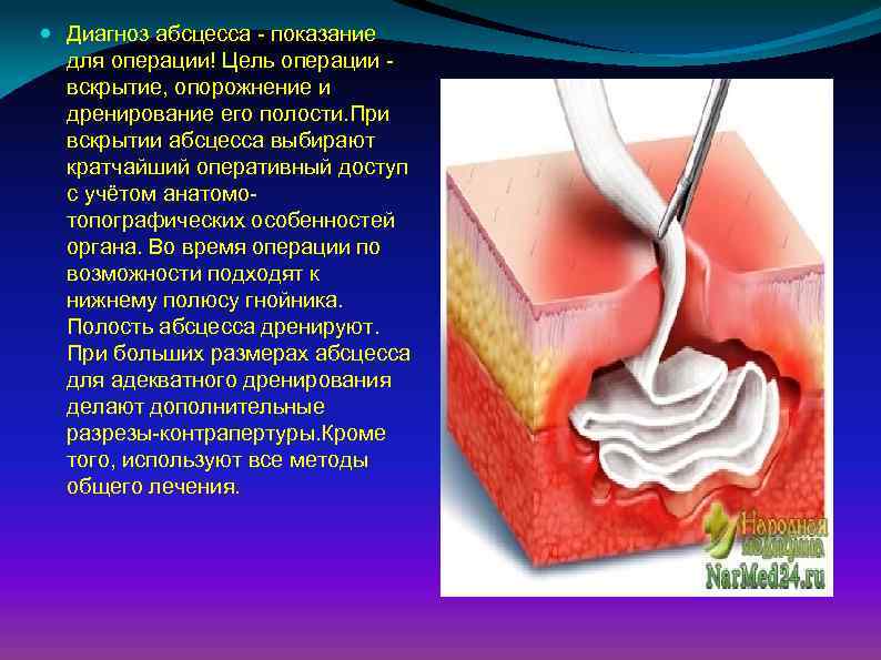  Диагноз абсцесса - показание для операции! Цель операции вскрытие, опорожнение и дренирование его