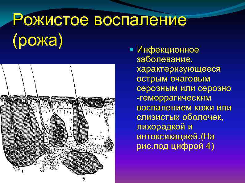 Рожа заболевание патогенез картинки