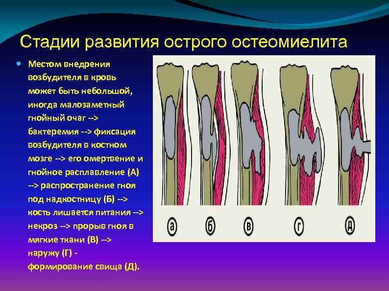 Развитие острого остеомиелита