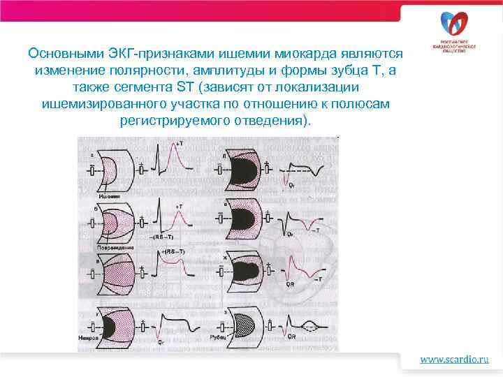 Основными ЭКГ-признаками ишемии миокарда являются изменение полярности, амплитуды и формы зубца Т, а также