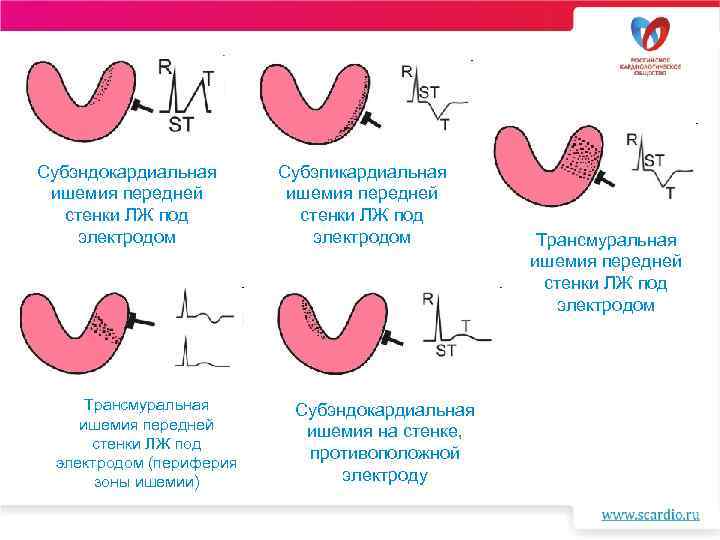 Субэндокардиальная ишемия боковой стенки