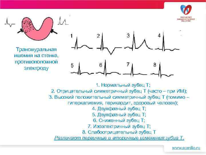 Трансмуральная ишемия на стенке, противоположной электроду 1. Нормальный зубец Т; 2. Отрицательный симметричный зубец
