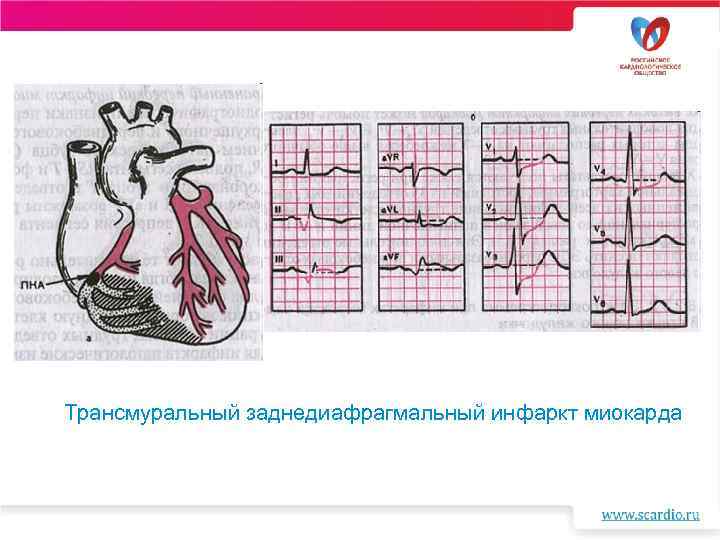 Признаки трансмурального инфаркта