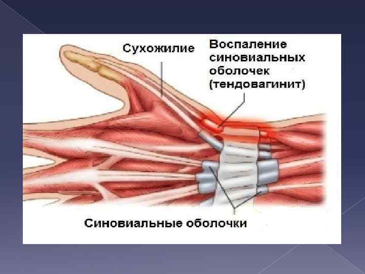 Тендовагинит де кервена. Болезнь де Кервена тендовагинит. Воспаление сухожилия тендовагинит. Тендовагинит сухожилий лучезапястного.